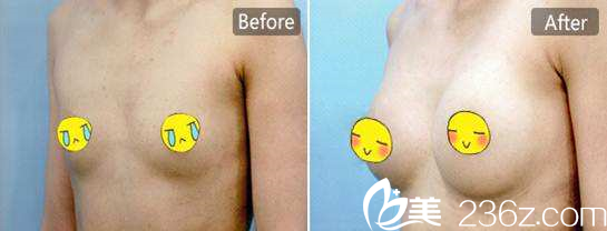 夏文森博士假體隆胸真人效果