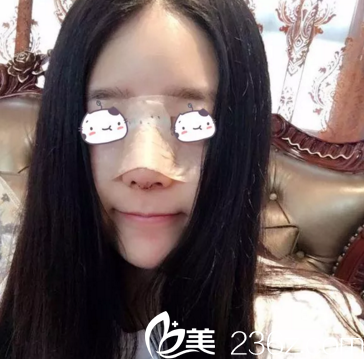 鼻綜合案例術(shù)后1周重慶美侖美奐