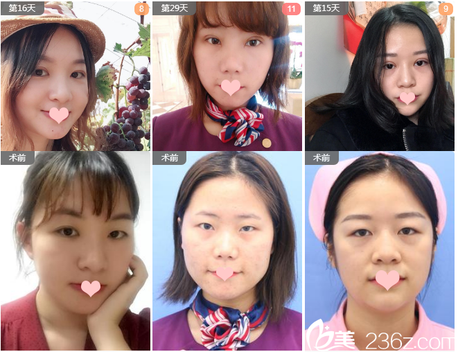 看柳州華美的雙眼皮