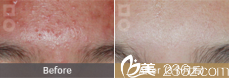 美爾韓祛除青春痘<span style= 美爾韓祛除青春痘<span style=