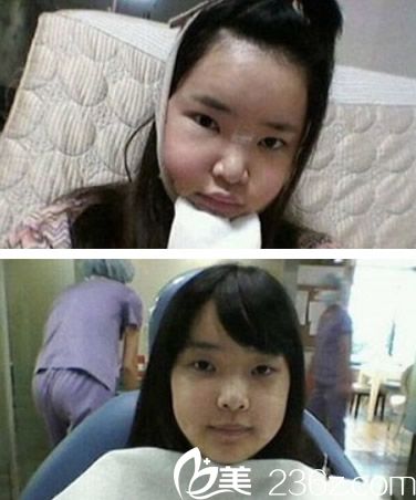 歐菲自體脂肪填充術(shù)前準備