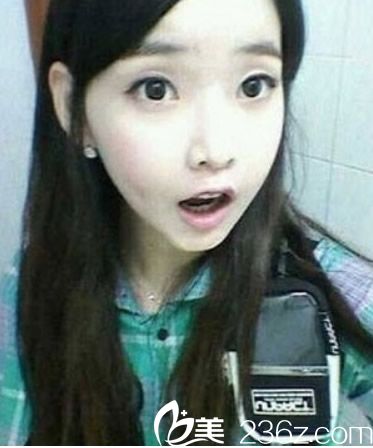 我在泉州歐菲找王偉韜做自體脂肪填充下巴效果好嗎？