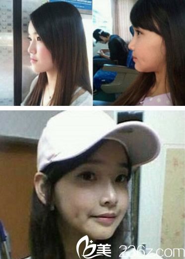 歐菲王主任填充下巴效果對比