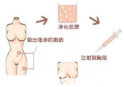 麥恩醫(yī)院自體脂肪豐胸脂肪提取過程