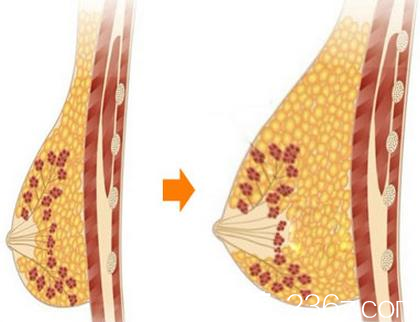 韓國麥恩醫(yī)院自體脂肪豐胸前后對比