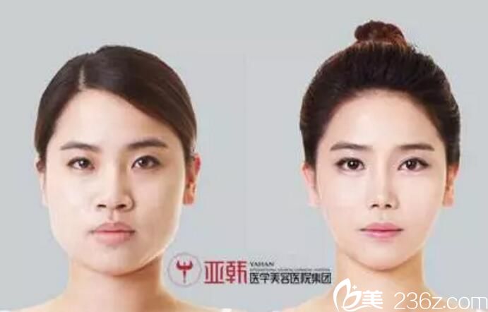 長沙亞韓趙貴慶打造的案例 隆鼻雙眼皮 長沙亞韓趙貴慶打造的案例 隆鼻雙眼皮