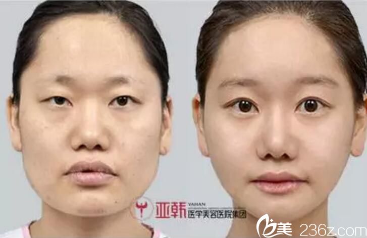 長沙亞韓趙貴慶雙眼皮真人案例 長沙亞韓趙貴慶雙眼皮真人案例