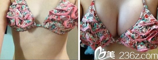 韓國嫵麗整形外科醫(yī)院姜民赫院長隆胸怎么樣？