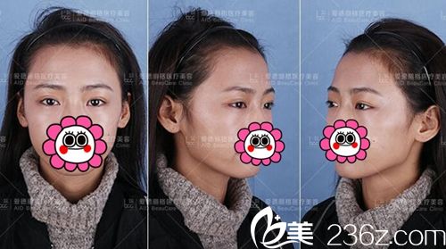 大連愛德麗格做雙眼皮修復(fù)手術(shù)前.jpg 大連愛德麗格做雙眼皮修復(fù)手術(shù)前.jpg