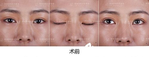 大連愛德麗格做雙眼皮修復(fù)手術(shù)前拍照.jpg 大連愛德麗格做雙眼皮修復(fù)手術(shù)前拍照.jpg