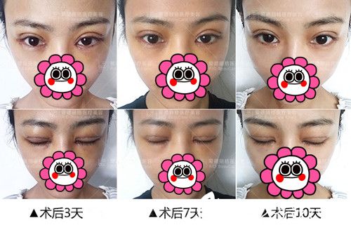 大連愛德麗格做雙眼皮修復(fù)手術(shù)后3-10天恢復(fù).jpg 大連愛德麗格做雙眼皮修復(fù)手術(shù)后3-10天恢復(fù).jpg