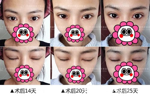 大連愛德麗格做雙眼皮修復(fù)手術(shù)14-25天恢復(fù).jpg 大連愛德麗格做雙眼皮修復(fù)手術(shù)14-25天恢復(fù).jpg