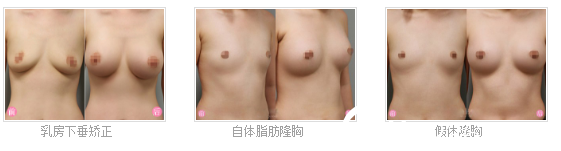 廣州曙光整形醫(yī)院隆胸案例 廣州曙光整形醫(yī)院隆胸案例