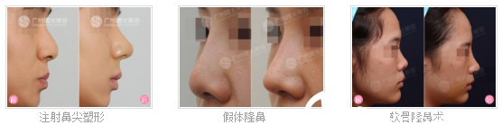 廣州曙光整形醫(yī)院做的隆鼻案例 廣州曙光整形醫(yī)院做的隆鼻案例