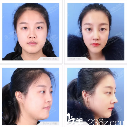 柳州華美王文鼻綜合修復(fù)案例 柳州華美王文鼻綜合修復(fù)案例