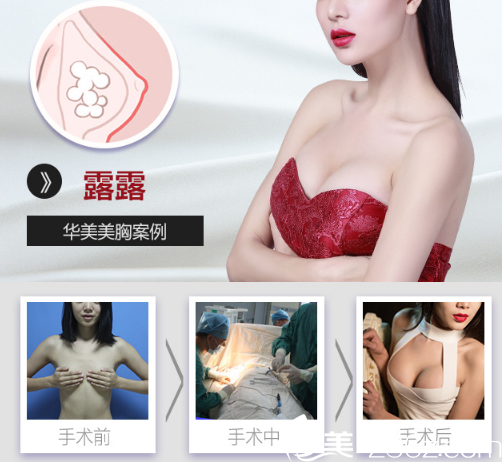 柳州華美整形醫(yī)院蘭磊隆胸案例對比圖