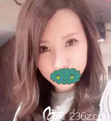 內(nèi)雙大鼻子到海南夢(mèng)妮幻做眼綜合+鼻綜合整形花了15600元