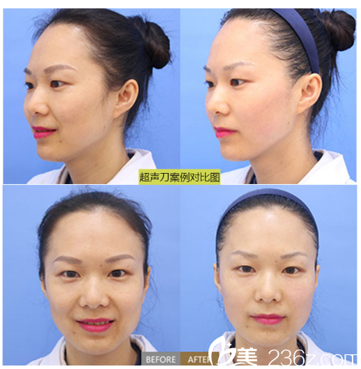 柳州華美整形醫(yī)院劉文先真人案例