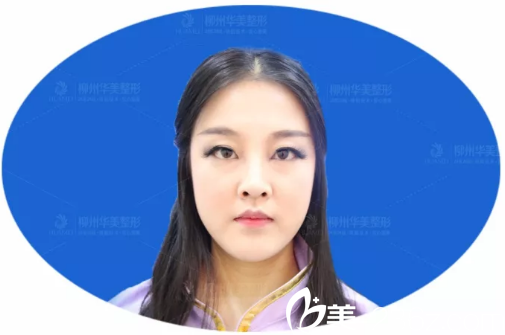 朝天鼻修復(fù)術(shù)前照片 朝天鼻修復(fù)術(shù)前照片