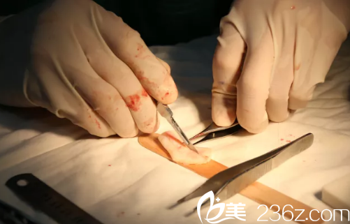 雕刻肋軟骨 雕刻肋軟骨