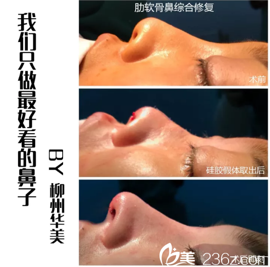 柳州華美隆鼻怎么樣？王文院長肋軟骨鼻綜合修復(fù)案例過程大起底