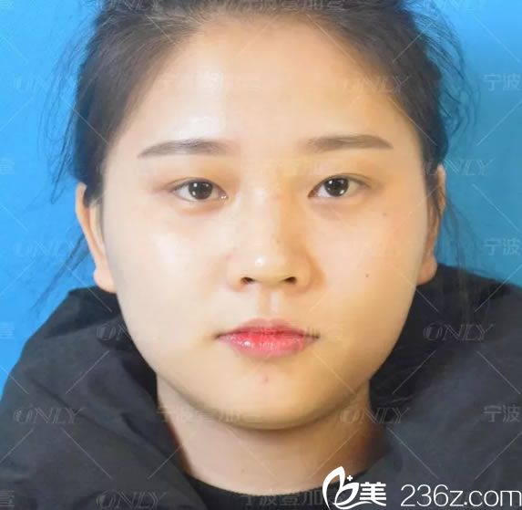 做雙眼皮和隆鼻前的小白 做雙眼皮和隆鼻前的小白