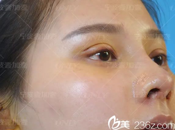 做完鼻綜合7天拆線的<span style= 做完鼻綜合7天拆線的<span style=