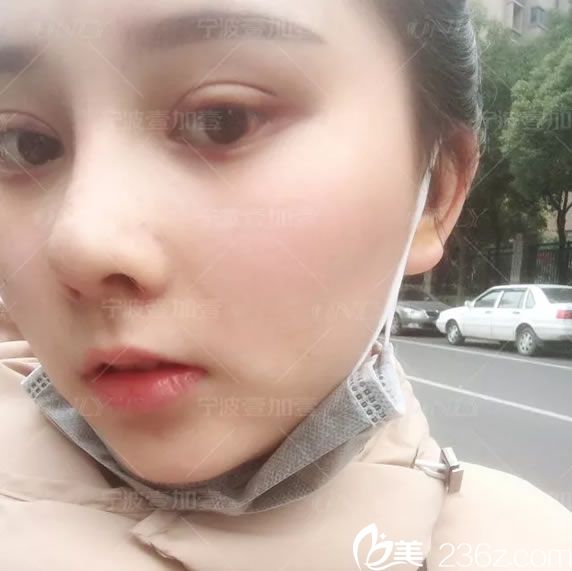 寧波壹加壹護(hù)士做雙眼皮和隆鼻15天<span style= 寧波壹加壹護(hù)士做雙眼皮和隆鼻15天<span style=