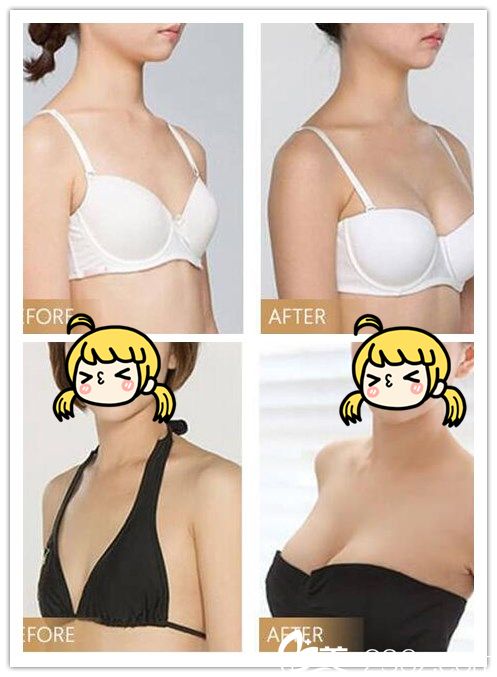 華美醫(yī)院劉濤胸部整形效果案例 華美醫(yī)院劉濤胸部整形效果案例