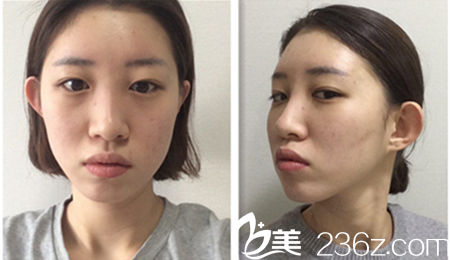 韓國(guó)omega整形外科醫(yī)院真人整形案例術(shù)前照 韓國(guó)omega整形外科醫(yī)院真人整形案例術(shù)前照