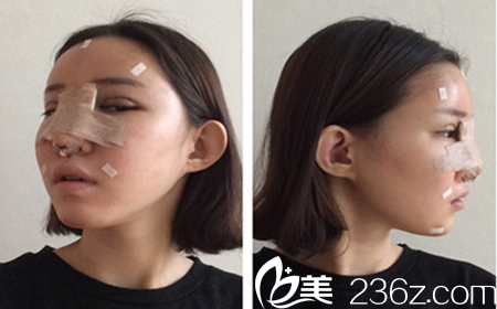 韓國(guó)Omega整形外科醫(yī)院真人案例手術(shù)當(dāng)天照 韓國(guó)Omega整形外科醫(yī)院真人案例手術(shù)當(dāng)天照