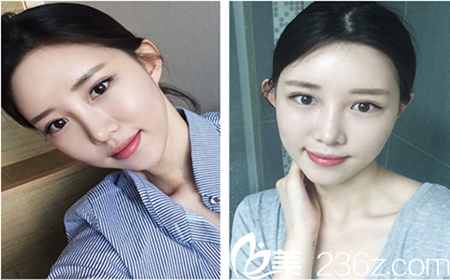 韓國(guó)Omega(歐米茄)整形外科真人手術(shù)案例術(shù)后三周效果 韓國(guó)Omega(歐米茄)整形外科真人手術(shù)案例術(shù)后三周效果