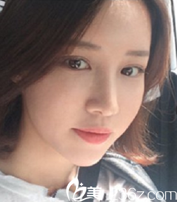 韓國(guó)Omega(歐米茄)整形外科醫(yī)院真人整形案例術(shù)后兩個(gè)月照 韓國(guó)Omega(歐米茄)整形外科醫(yī)院真人整形案例術(shù)后兩個(gè)月照