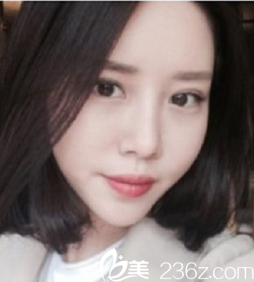 韓國omega整形外科醫(yī)院柳在億院長做隆鼻+自體脂肪填充怎么樣？真人案例