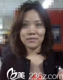 韓國431整形外科金載勛院長隆鼻怎么樣？真人案例