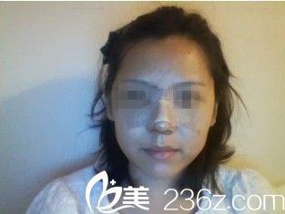 金載勛院長隆鼻術(shù)后三天 金載勛院長隆鼻術(shù)后三天