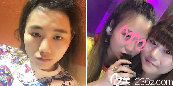 做手術(shù)前的塌鼻子和單眼皮 做手術(shù)前的塌鼻子和單眼皮