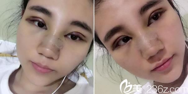 做雙眼皮開(kāi)眼角手術(shù)第3天 做雙眼皮開(kāi)眼角手術(shù)第3天