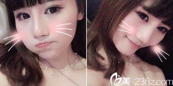 雙眼皮和隆鼻手術(shù)1個(gè)月恢復(fù)照 雙眼皮和隆鼻手術(shù)1個(gè)月恢復(fù)照