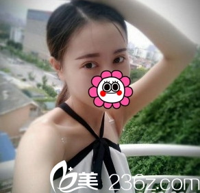 長(zhǎng)治悅美雙眼皮術(shù)后1天效果 長(zhǎng)治悅美雙眼皮術(shù)后1天效果