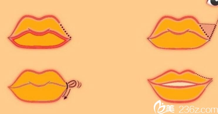 wrap-around corner lift 嘴角上揚