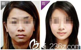 樸英進院長童顏術真人案例 樸英進院長童顏術真人案例