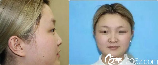 假體隆鼻術前塌鼻子 假體隆鼻術前塌鼻子