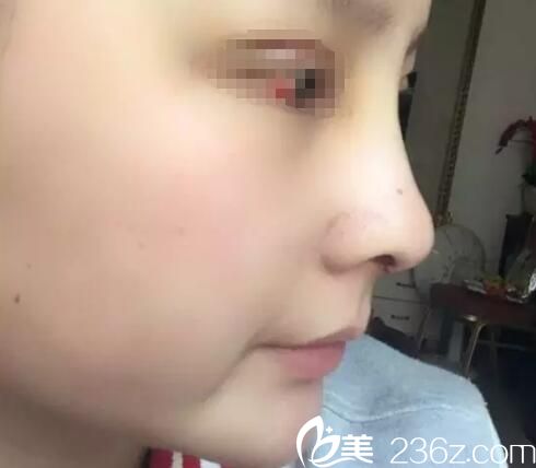 隆鼻后七天拆線效果 隆鼻后七天拆線效果