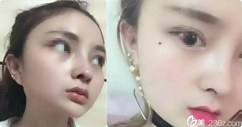 找鎮(zhèn)江蘇王徐佳明院長6500元夠做假體隆鼻嗎?案例效果怎么樣