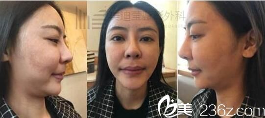 韓國美迪瑩整形真人案例1 韓國美迪瑩整形真人案例1