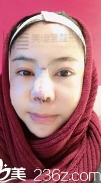 韓國美迪瑩整形真人案例3 韓國美迪瑩整形真人案例3