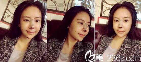 韓國美迪瑩整形真人案例4 韓國美迪瑩整形真人案例4