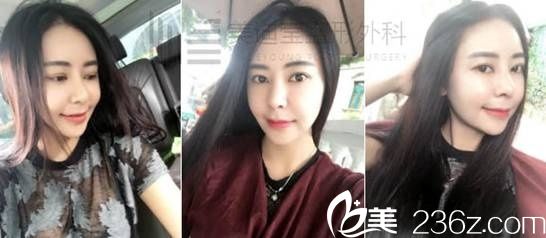 分享我在韓國(guó)美迪瑩徐范信做面部吸脂+埋線提升+取頰脂墊+下巴肌肉捆綁塑形+鼻子整形