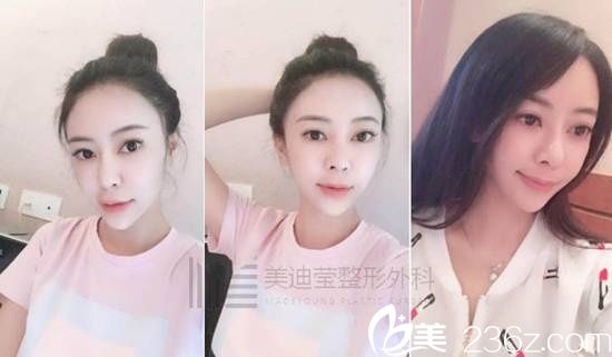 韓國美迪瑩整形真人案例6 韓國美迪瑩整形真人案例6